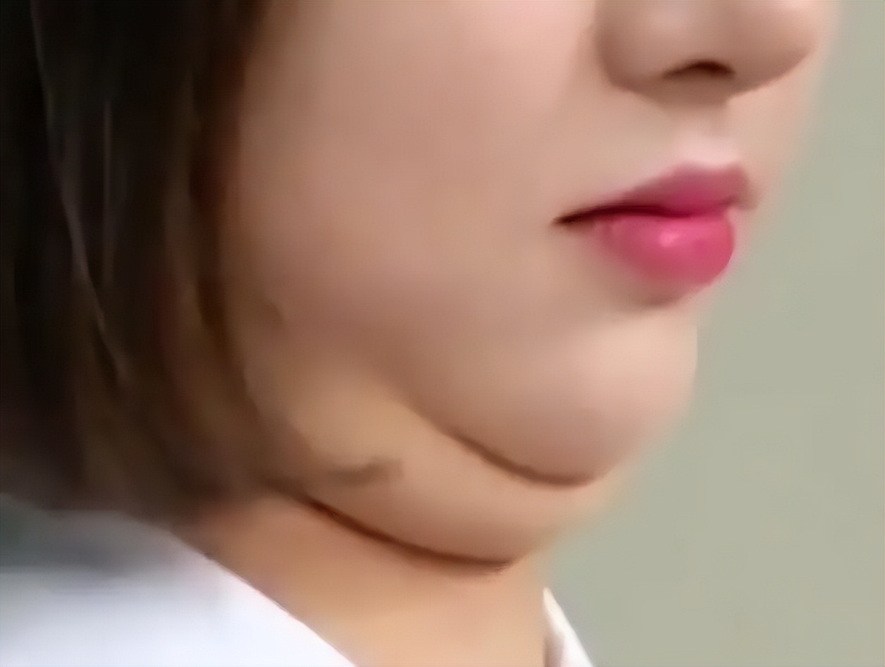 双下巴怎么改善最有效,双下巴怎么解决