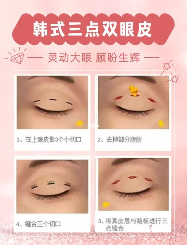 广州做双眼皮好的三甲医院和医生,西京医院双眼皮哪个医生做得好