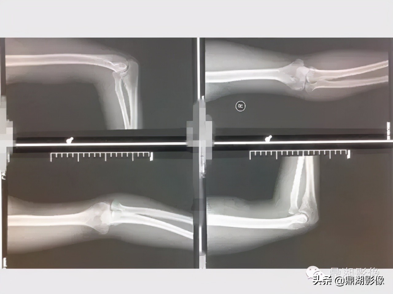 先天桡骨缺失畸形能治疗吗,先天性桡骨发育不良