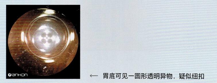 胃里有异物能做胃镜吗,磁控胶囊胃镜的胶囊怎么排出来