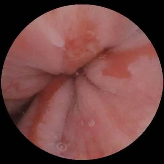 磁控胶囊胃镜检测信号,磁控胶囊胃镜看得清楚吗