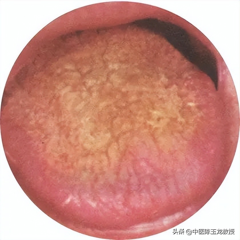 上焦湿热失眠目赤,肝胆湿热所致头晕目赤耳鸣耳聋