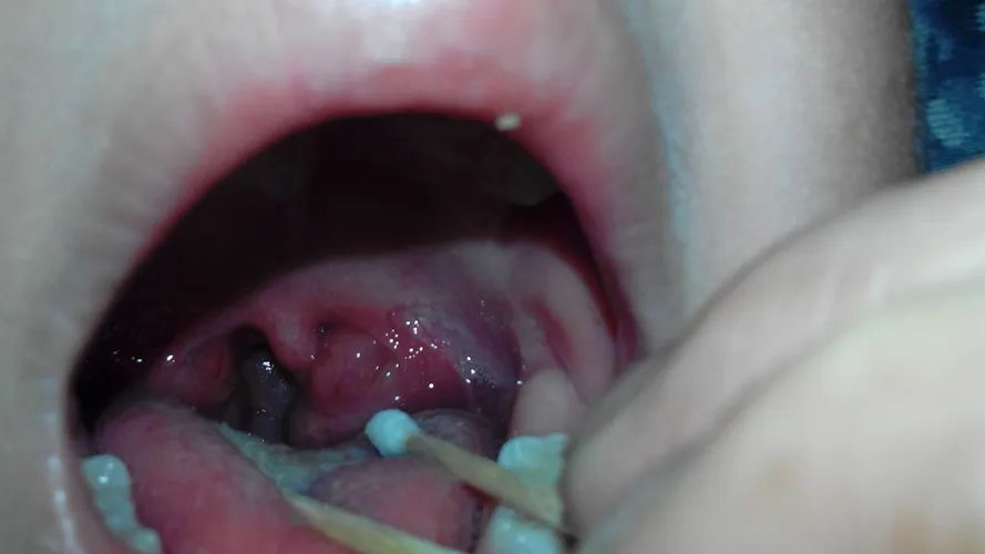 疱疹性咽峡炎怎么护理治疗好得快,儿科疱疹性咽峡炎护理诊断