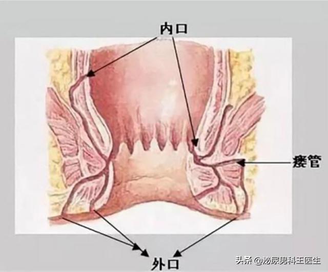 肛瘘不想做手术怎么保守治疗,为什么肛瘘手术后才是痛苦的开始