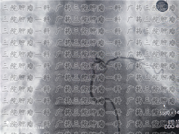 骨髓瘤误诊的可能性有多大,骨髓瘤能治愈吧