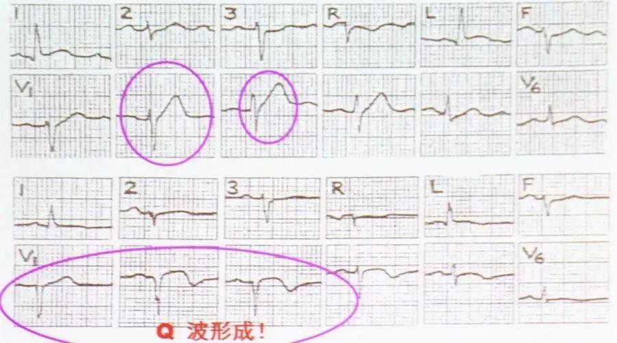 心梗吃什么药丹参滴丸,心梗用中药治疗有用吗