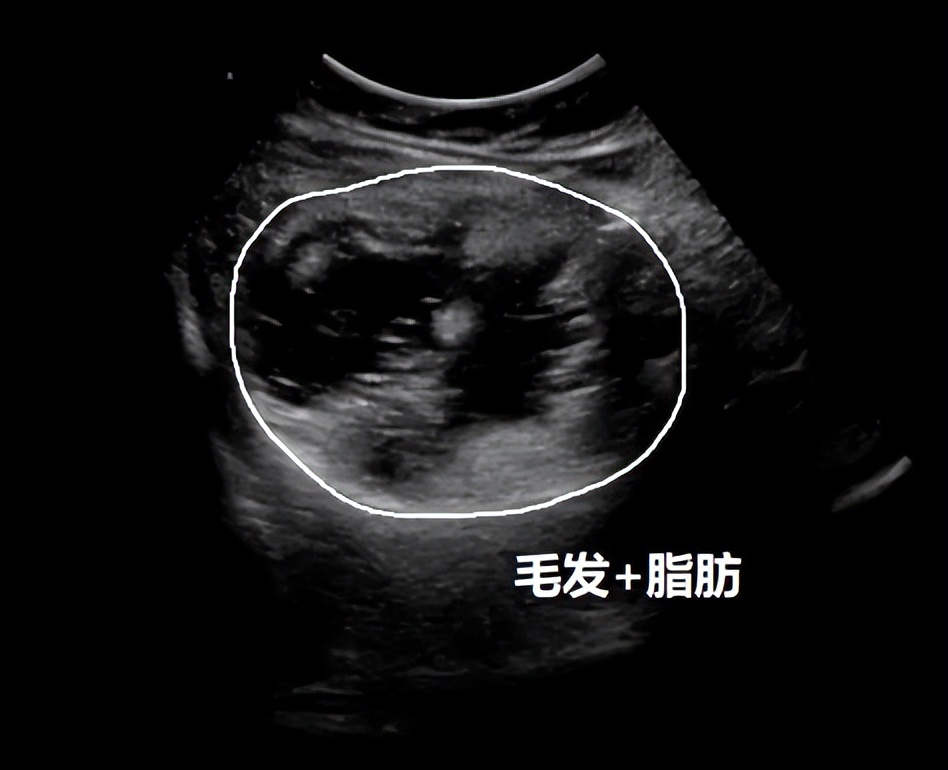 超声显示子宫肌瘤卵巢囊肿,显微镜下的卵巢囊肿