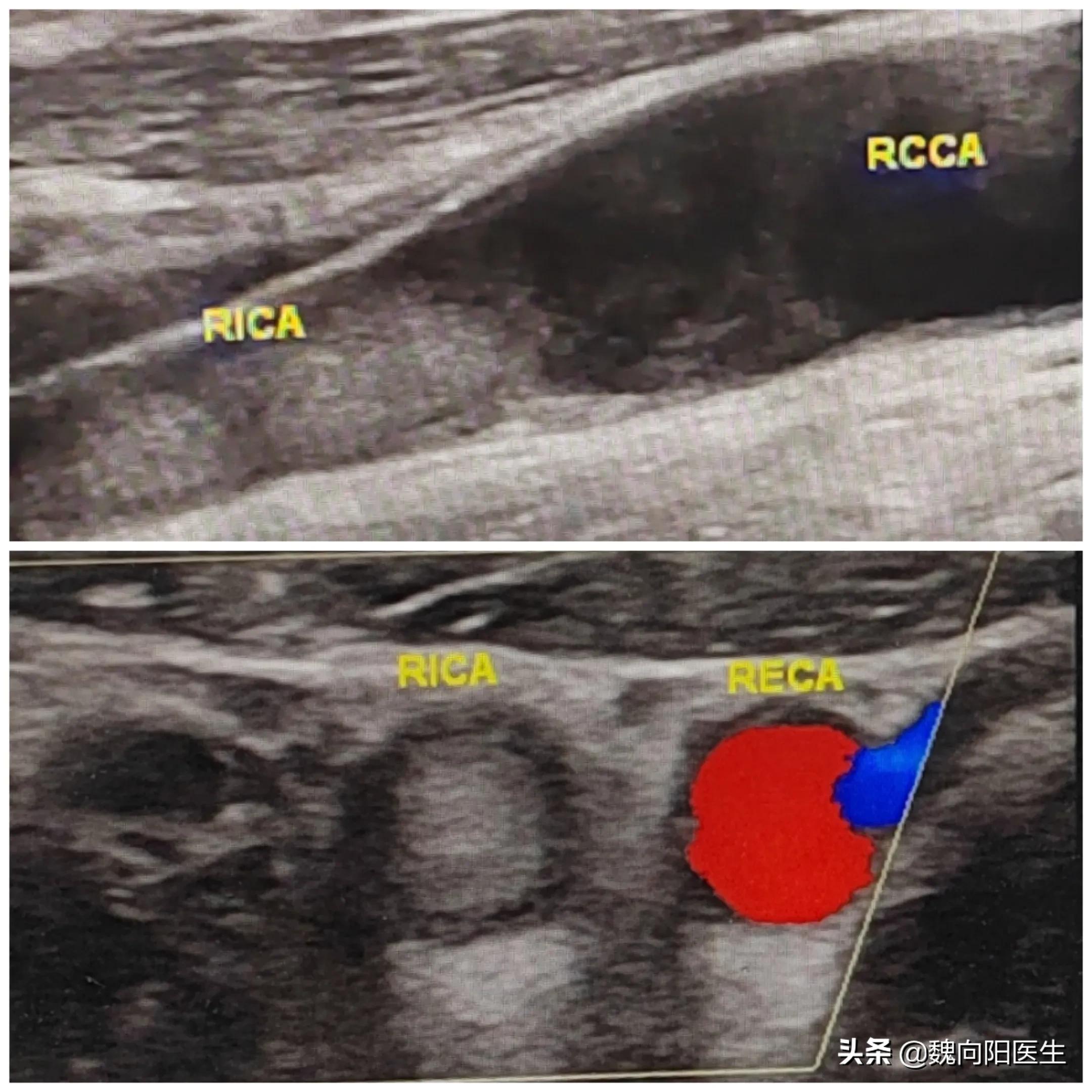 颈静脉血栓能完全溶掉吗,颈动脉血栓能用针管抽吗