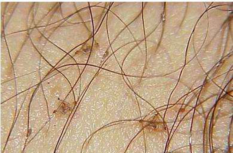 阴虱是什么？医生提醒：这些高危行为应该避免，要重视4个预防