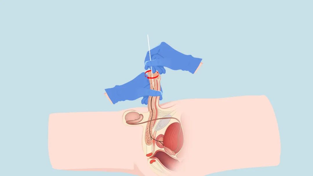 男人结扎后会*生活性**质量下降?来自已婚女人的自述,听完后都笑了