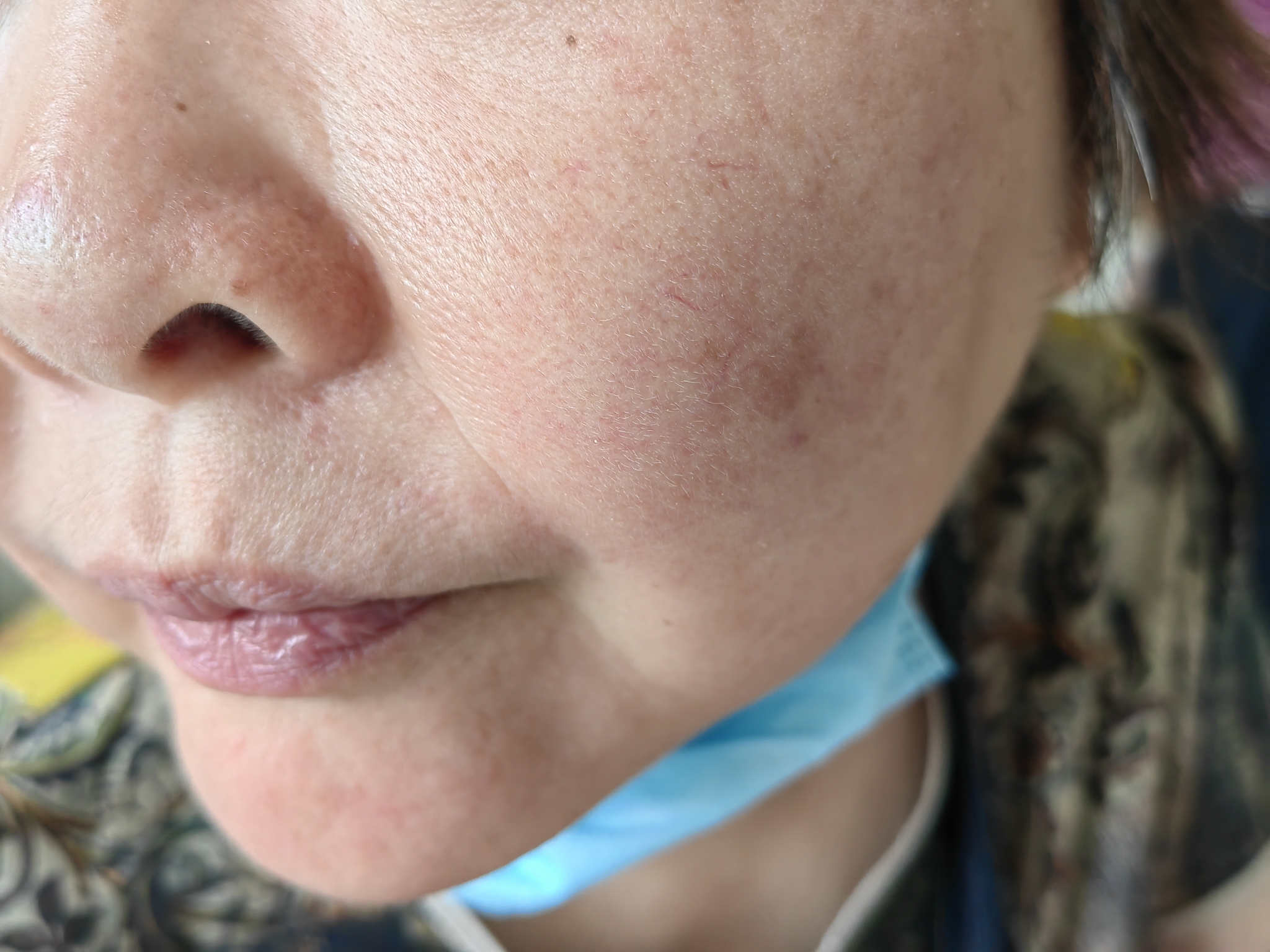 对镍过敏是怎么回事,镍过敏的人多不多