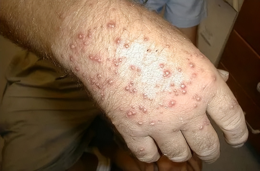 小宝宝出门怎么防护毒虫,带孩子出去玩当心这种虫子