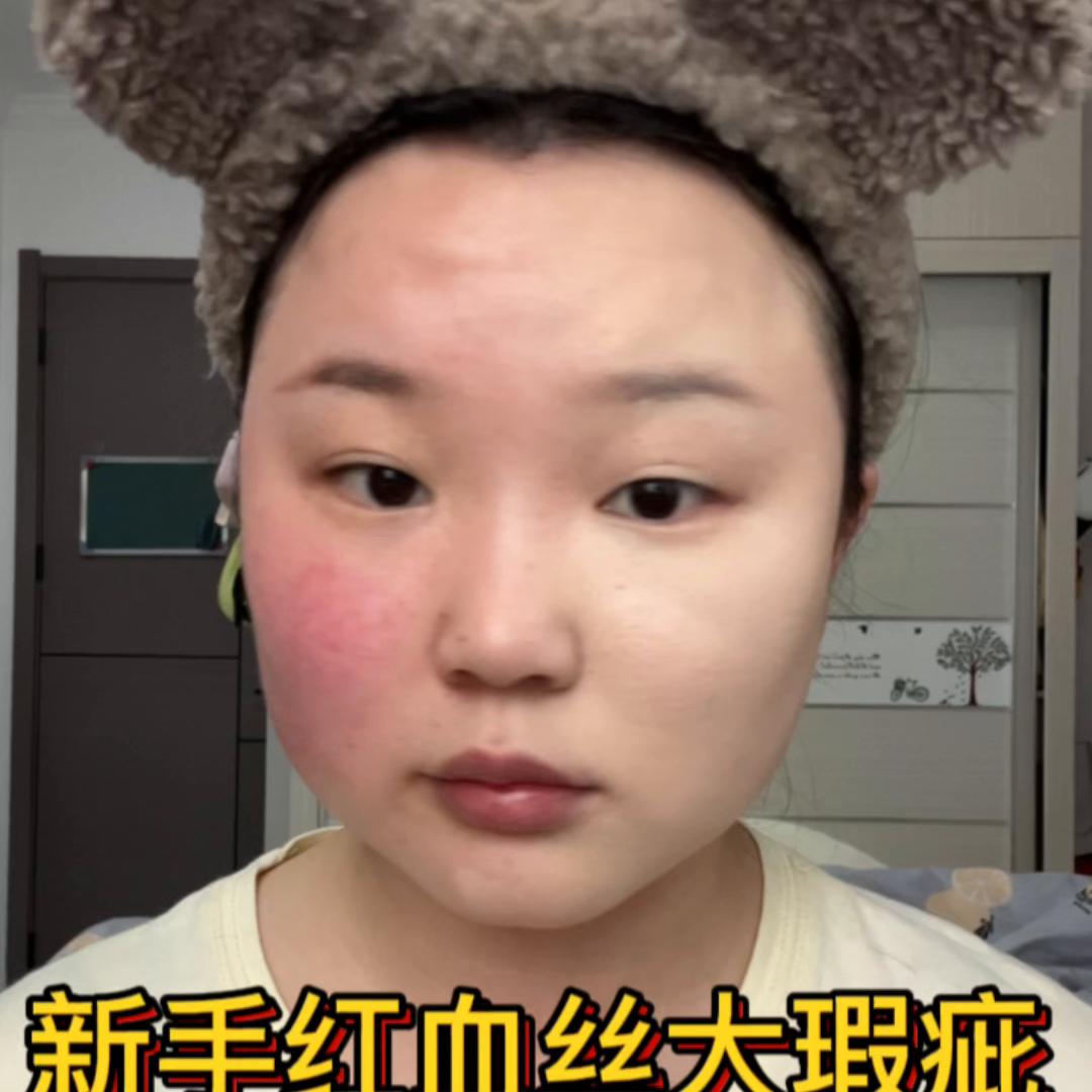 儿童妆嘴边红血丝怎么化,婴儿脸有红血丝能涂面霜吗