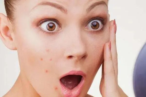 治痘过程中为什么频繁爆痘,战痘最快最有效方法是什么