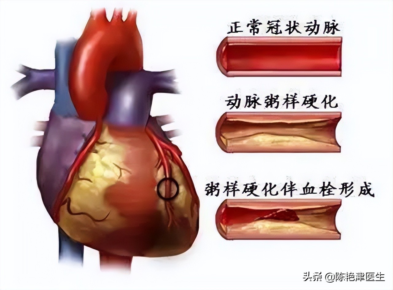 做完冠脉造影身体会虚弱吗,做完冠脉造影容易得癌症吗