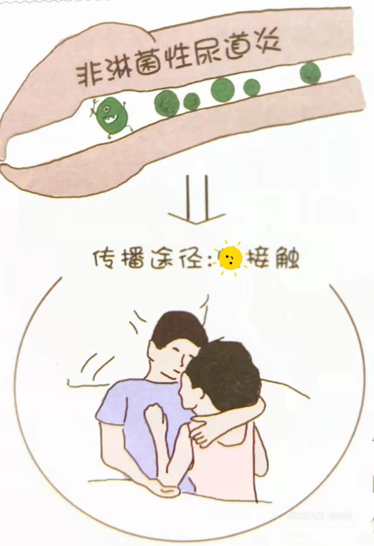 非淋菌性男性尿道炎初期,非淋菌性尿道炎就是淋病吗