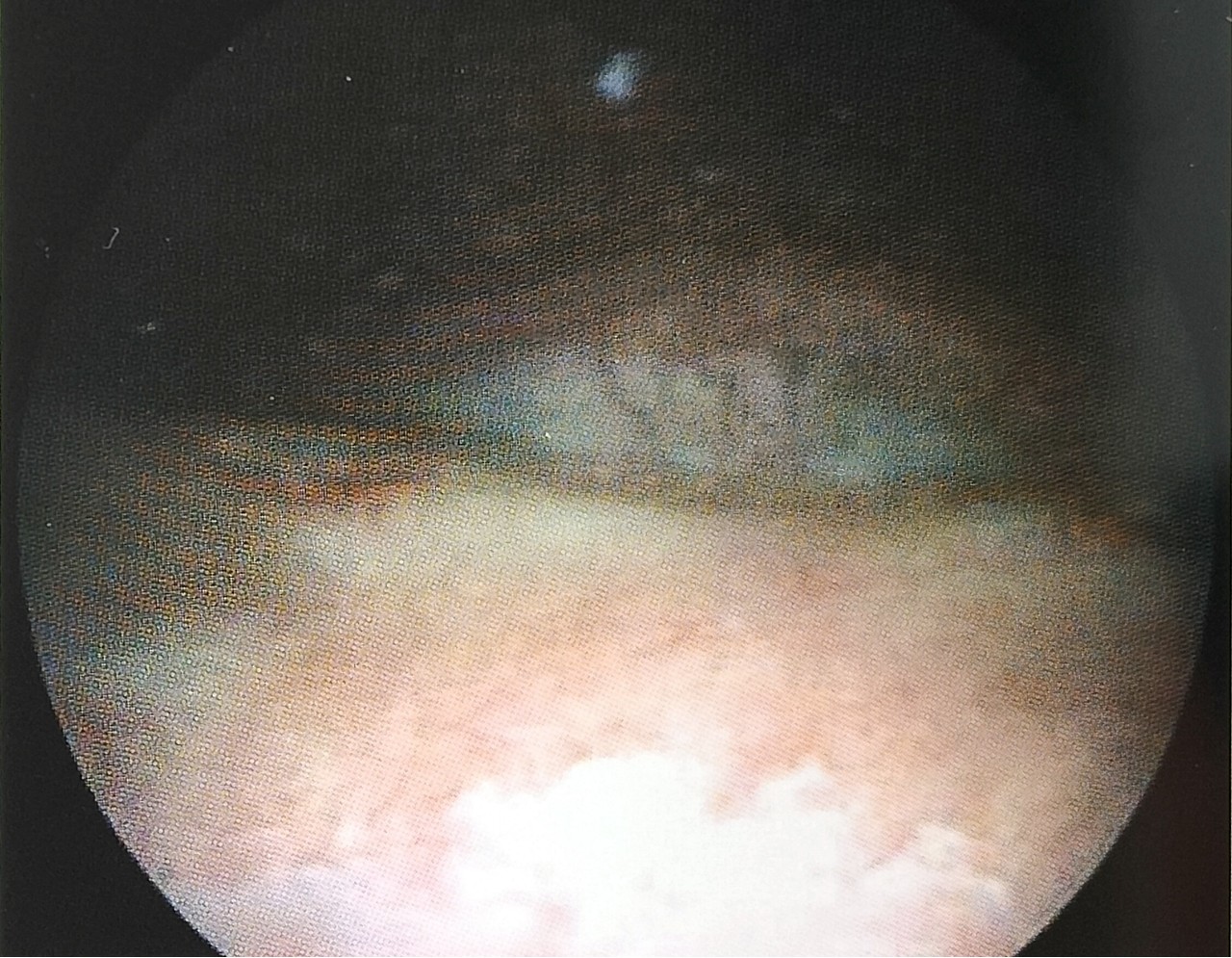 膀胱白斑电灼需要住院吗,膀胱白斑是什么