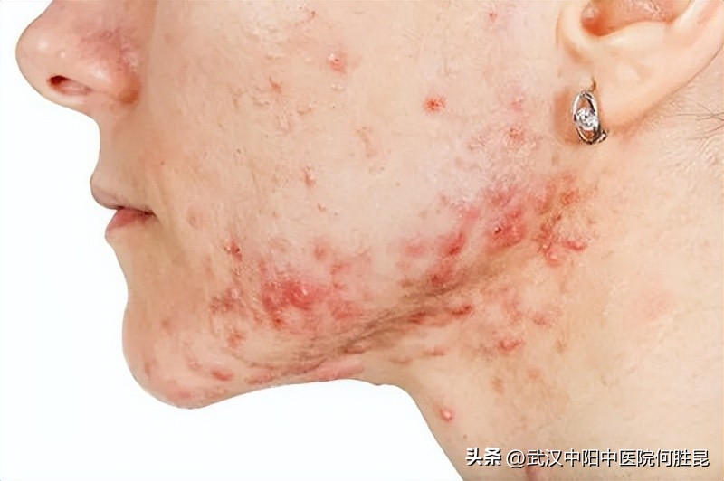 激光修复凸起疤痕疙瘩视频,激光治疗凸起疙瘩疤痕多少钱