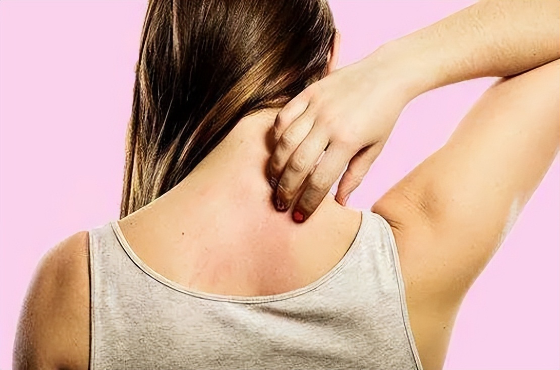 一到晚上皮肤就瘙痒荨麻疹,荨麻疹一到晚上就全身痒怎么调理