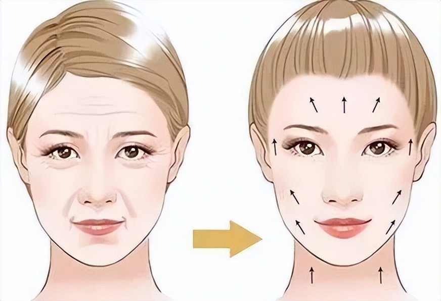 smas筋膜除皱效果怎么样,smas除皱手术需要用内窥镜吗