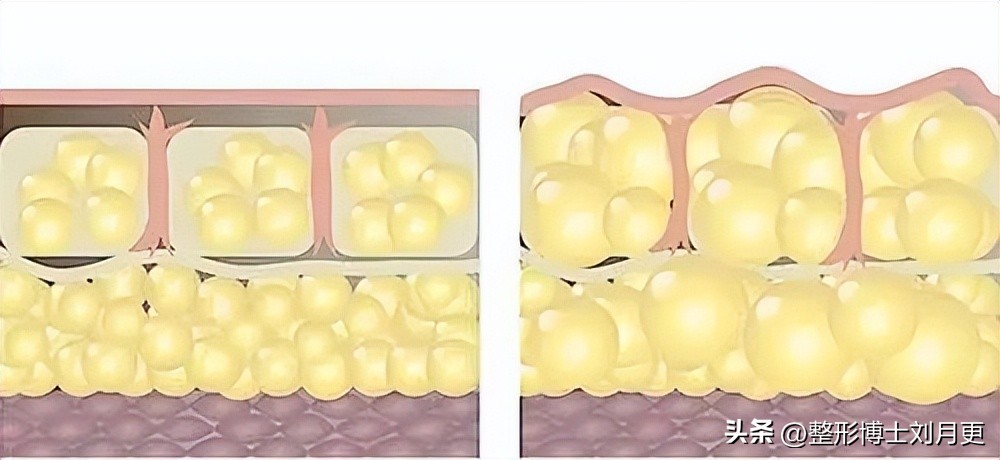 面部除皱用什么方法效果最好,面部除皱有什么方法效果好