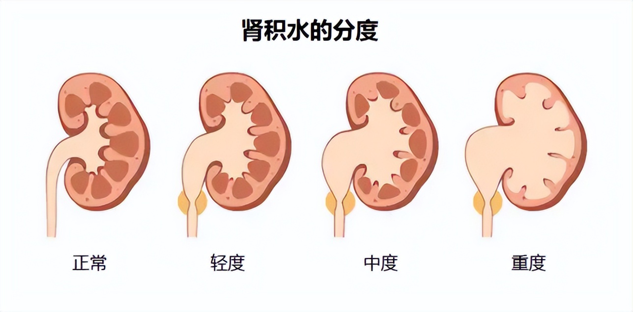 肾积水终极3问：一文解答肾积水患者90%的困惑