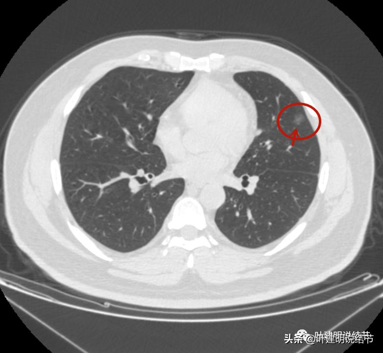 如何判断肺磨玻璃结节是高危结节,肺上有混合磨玻璃结节要注意什么