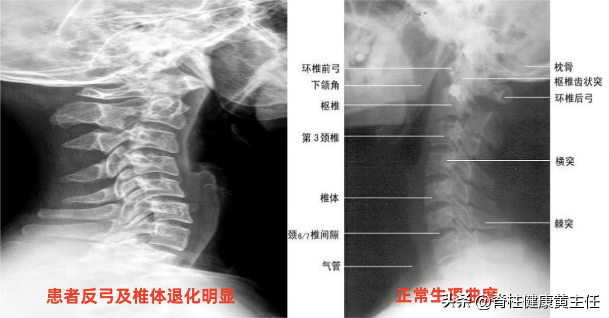 经常头痛颈椎痛是什么原因造成的,经常颈椎不好脖子疼痛是什么原因