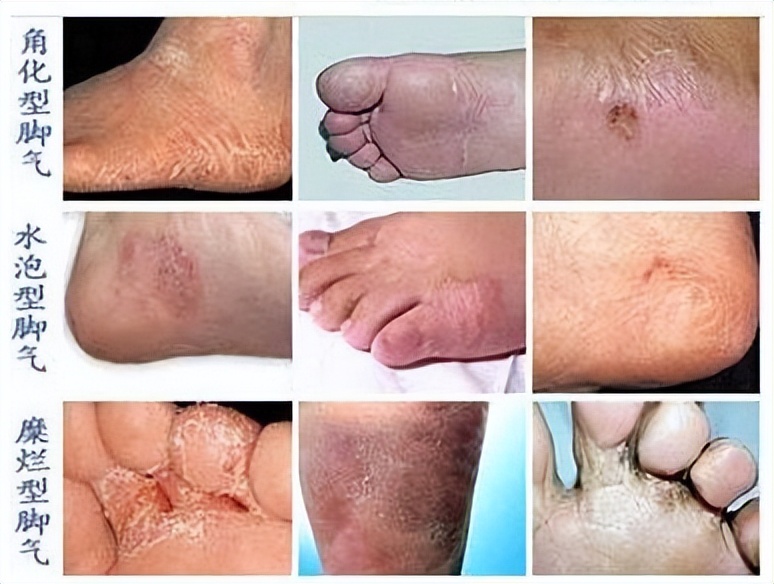 春天常见皮肤病怎么搭配用药,春季3种高发皮肤病应对方案