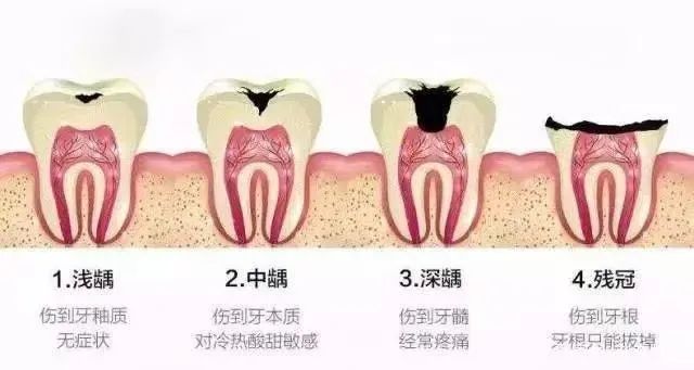 全瓷牙和烤瓷牙哪个质量好一点,全瓷牙和烤瓷牙的图片对比