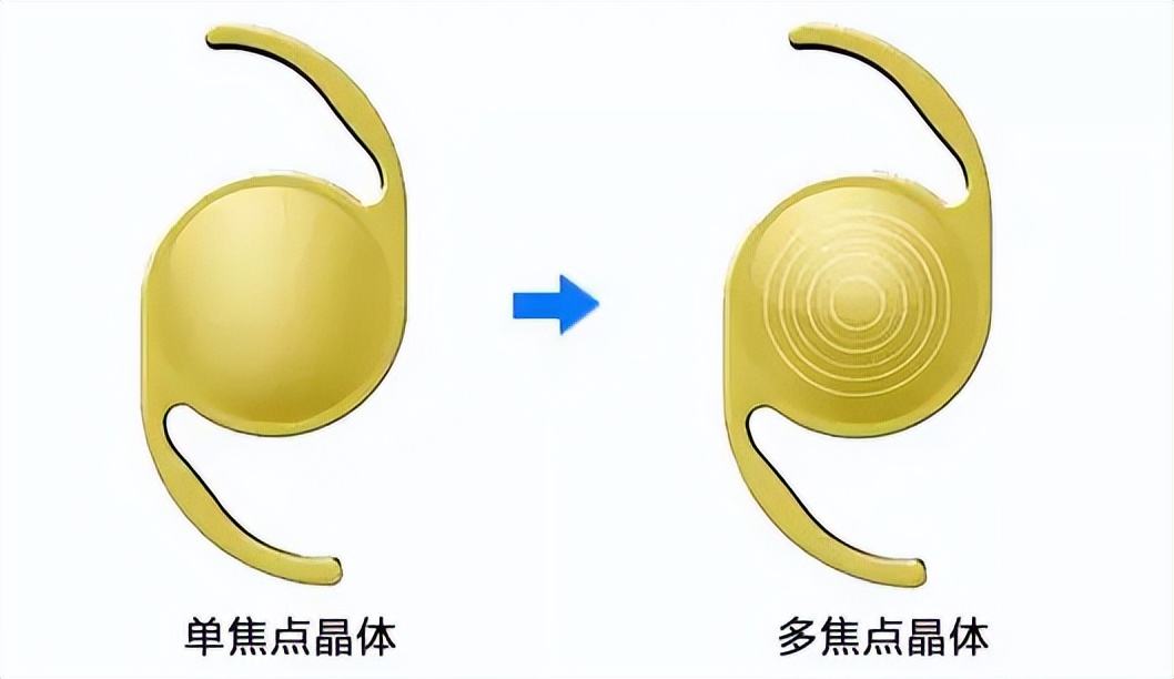 白内障最新晶体技术,白内障手术的晶体能矫正近视吗