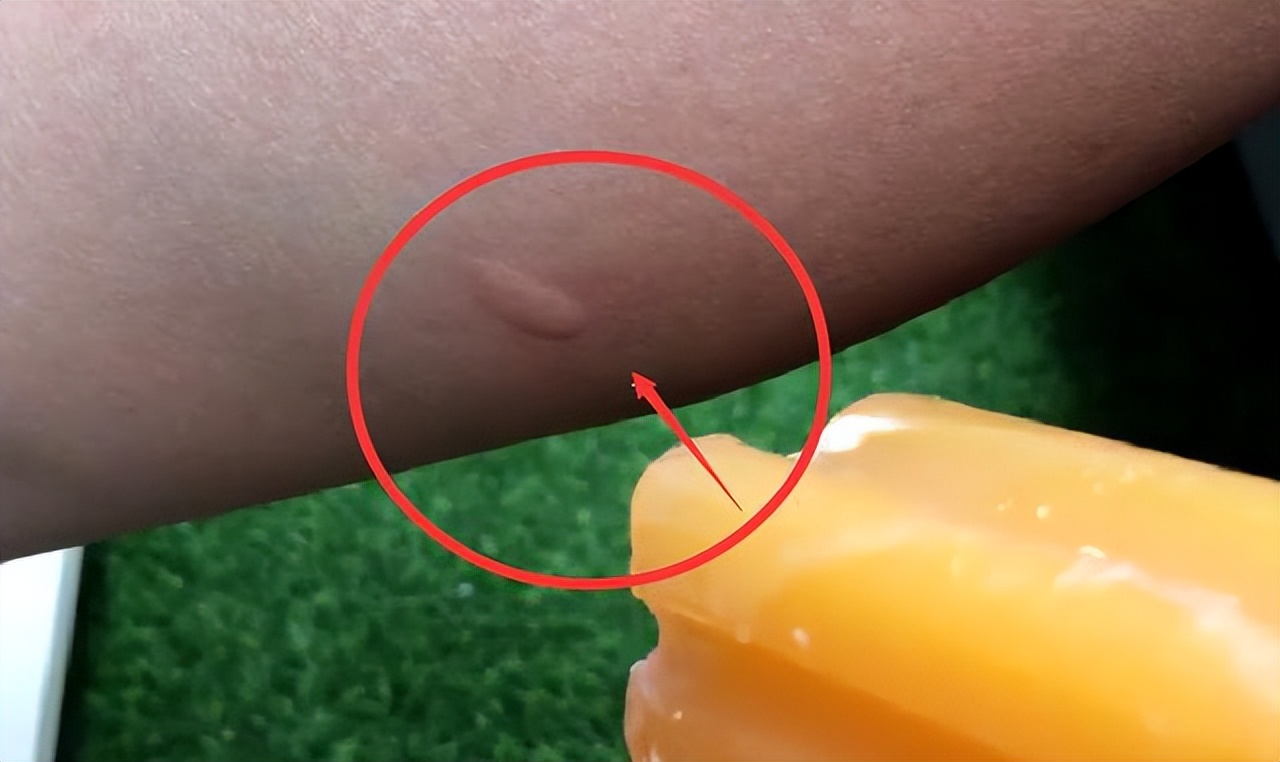 被蚊子咬快速止痒小妙招,蚊子咬的痒吃什么药止痒