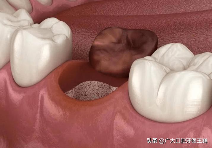 拔智齿为什么口腔溃疡更严重了,自从拔了智齿后牙齿经常出血