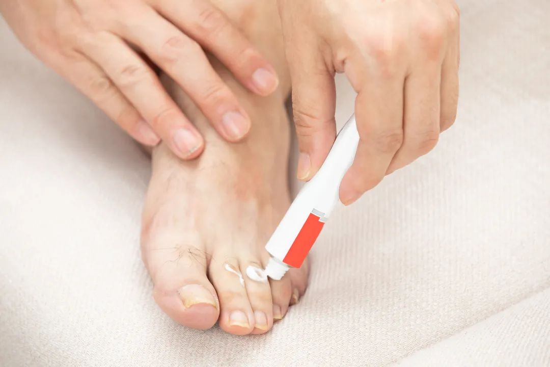 一到夏天就长脚气怎么治疗,一到夏季脚气就复发