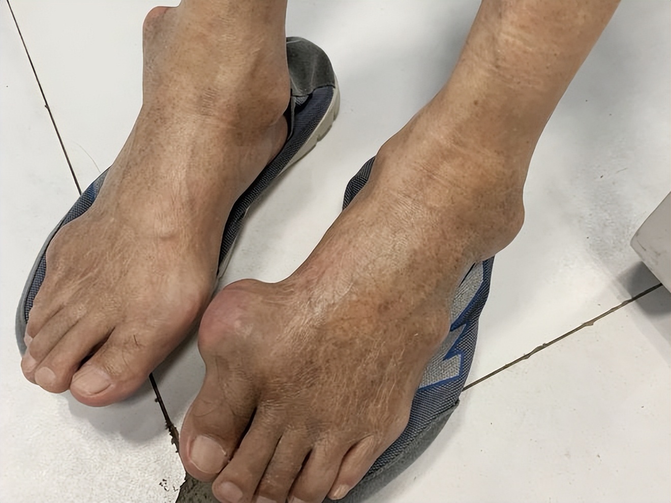 痛风与脚拇指外翻区别,痛风和大脚拇指外翻有何区别