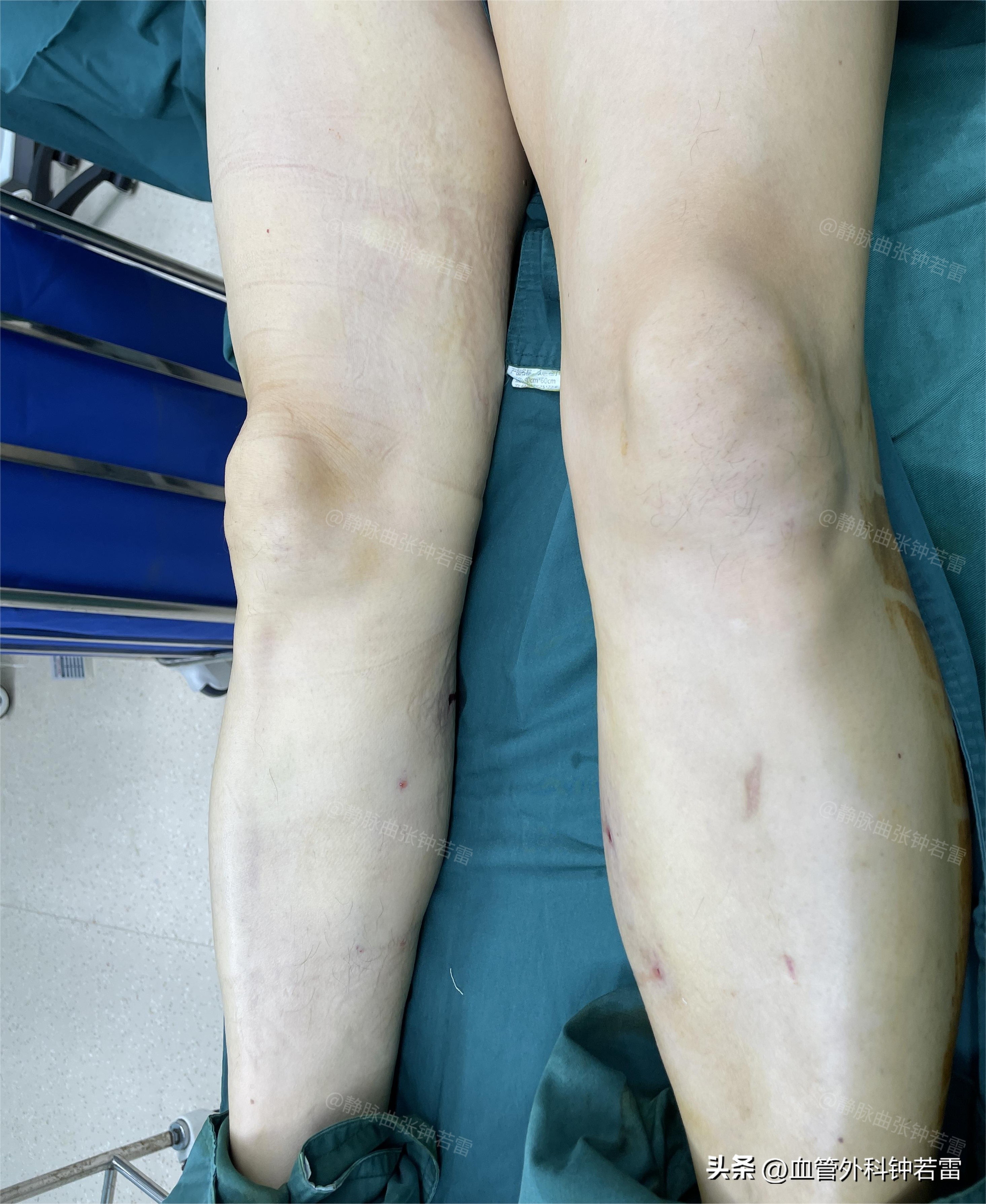 静脉曲张微创手术第一人,武汉张大哥