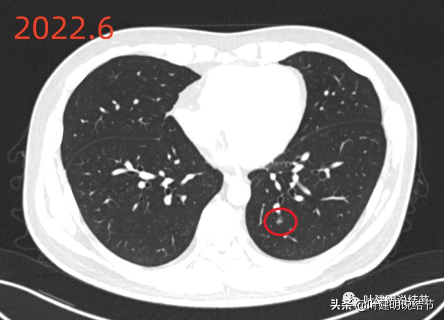 肺炎好了磨玻璃结节还存在,球形肺炎治愈后肺部留有结节
