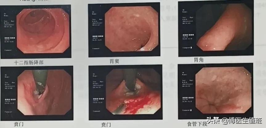 内镜切除贲门至胃底肿瘤,胃镜诊断贲门炎贲门息肉