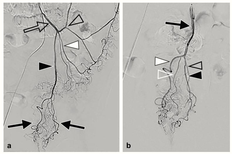 介入科治疗痔疮,介入微创治疗痔疮并出血