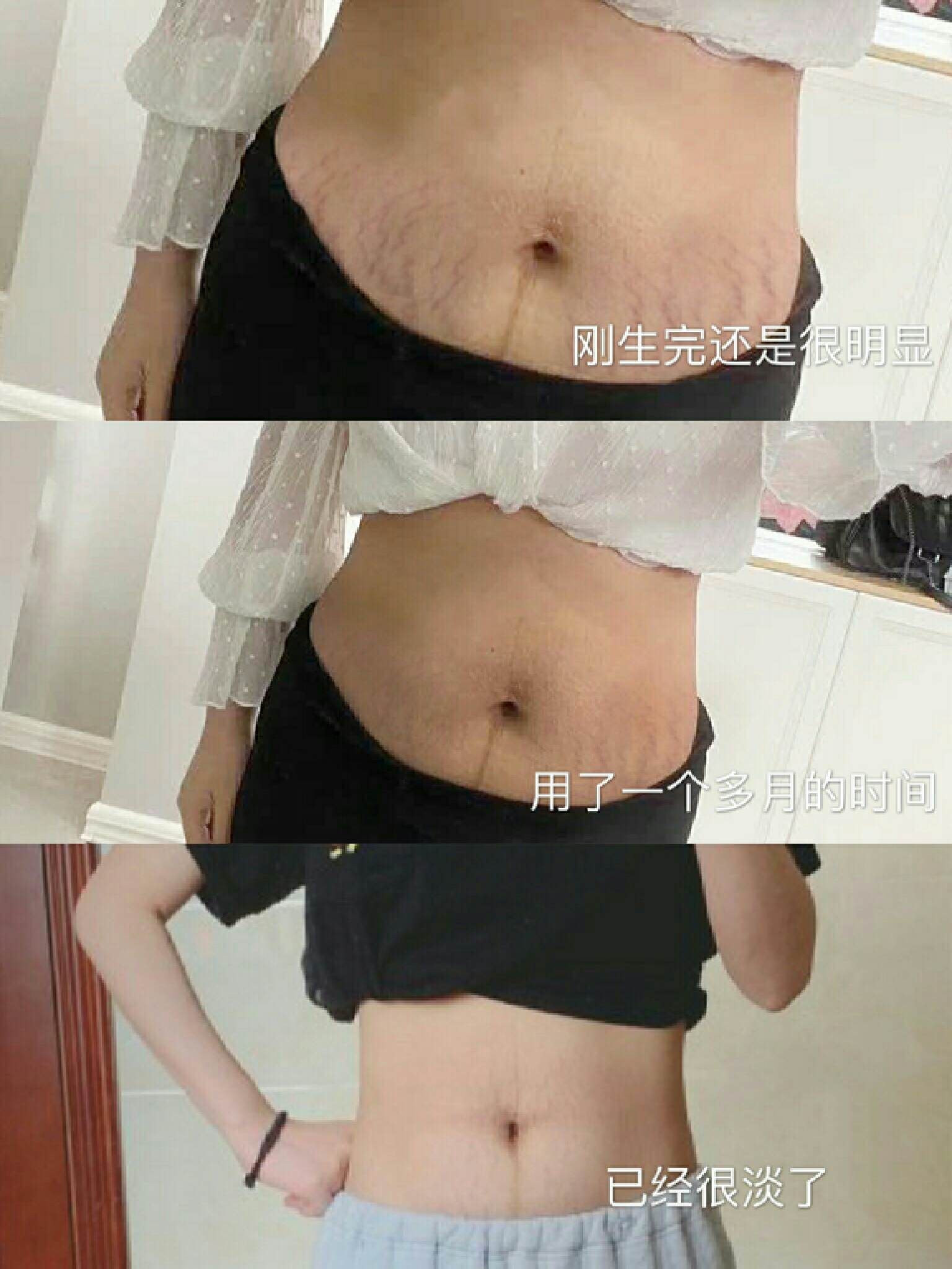 冻干粉淡斑修复妊娠纹,淡纹妊娠精华测评
