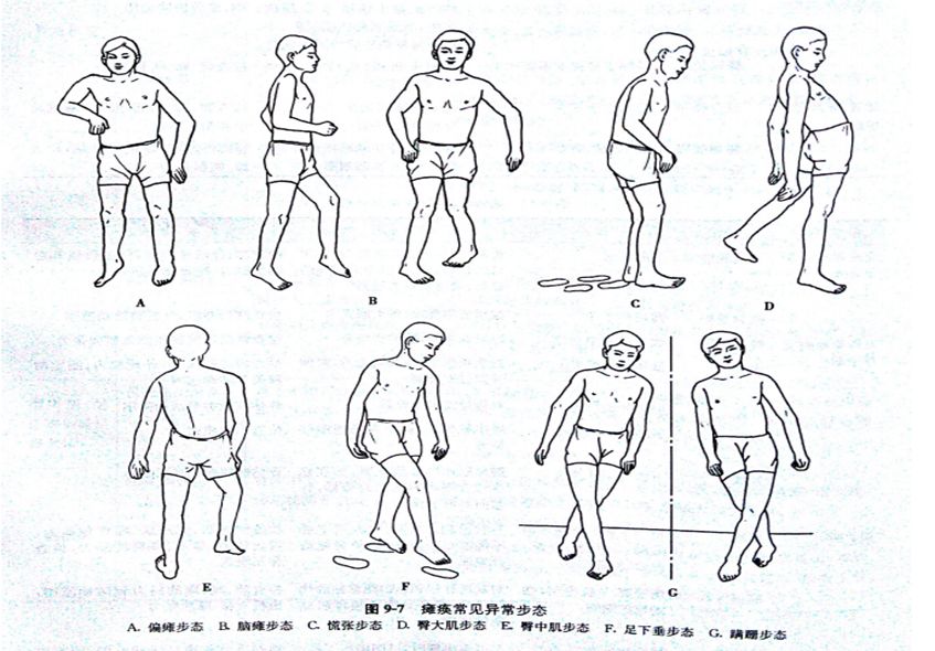 导致步态异常的常见原因,常见异常步态模式评定