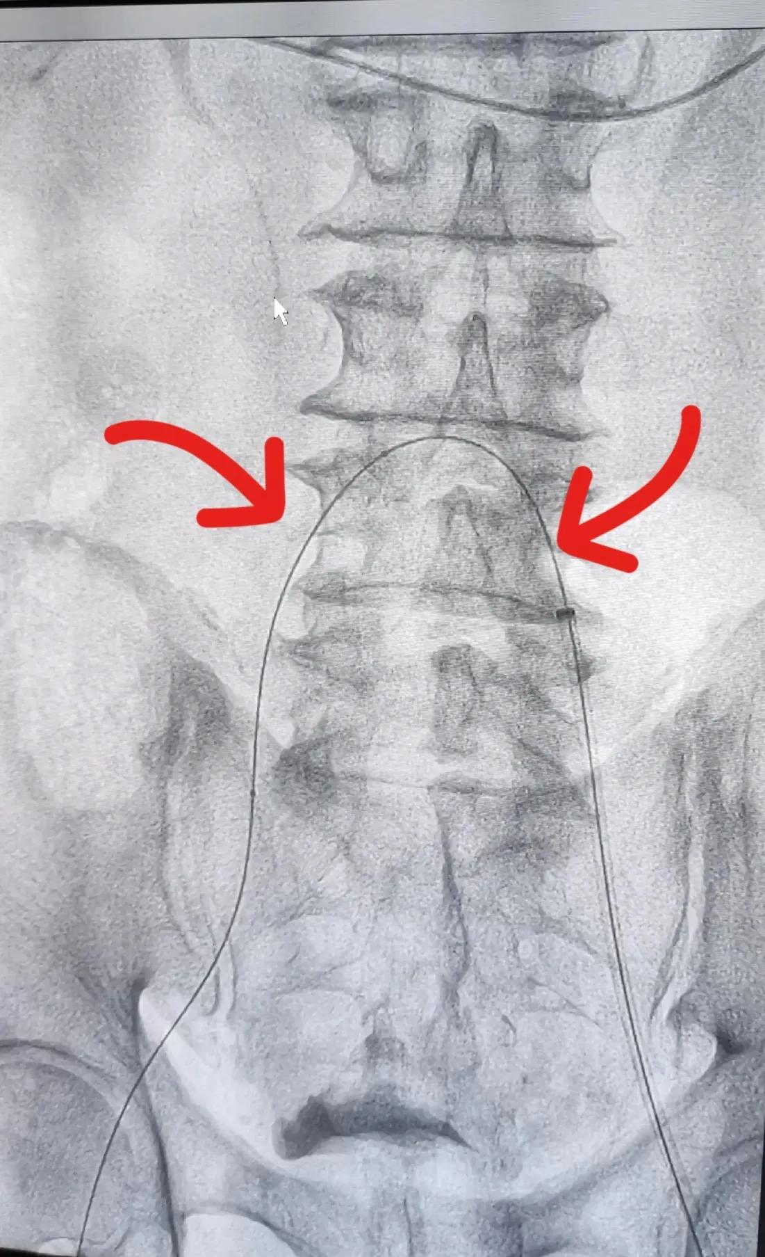 县级医院介入治疗下肢动脉硬化闭塞症