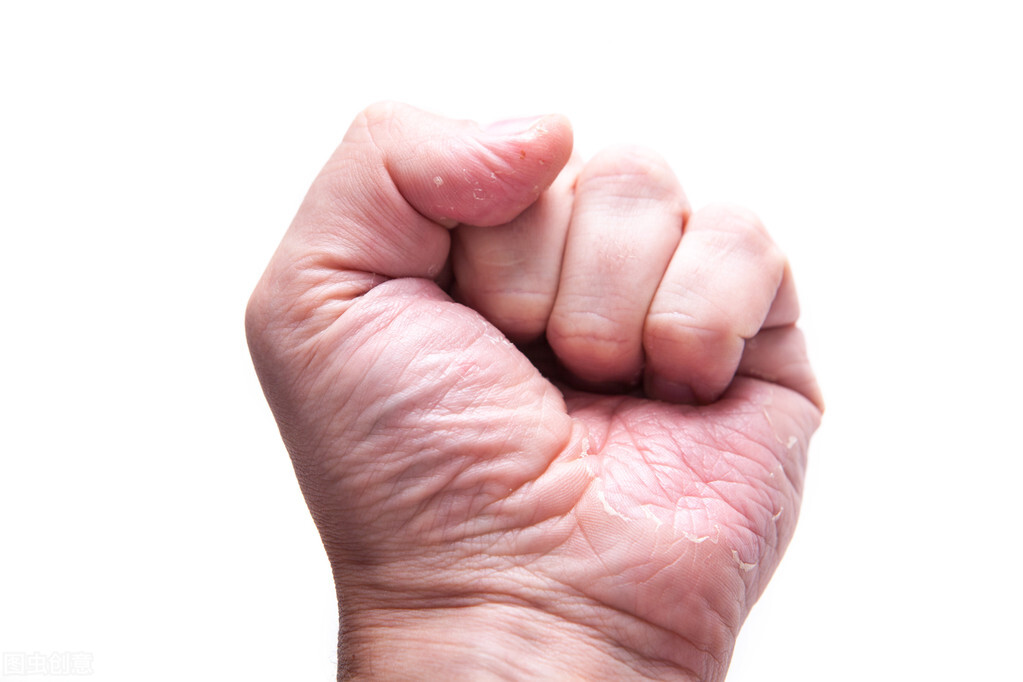 湿疹痛痒用什么药,男性生殖处湿疹瘙痒的药膏