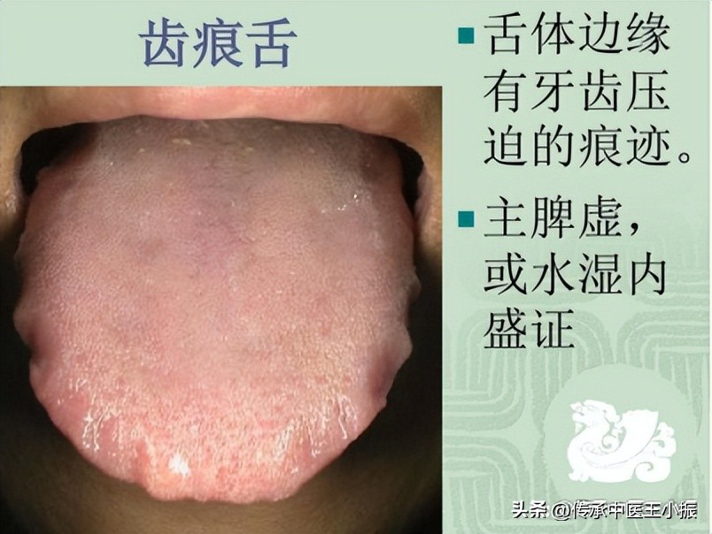 仲景如何鉴别五苓散和茯苓甘草汤,五苓散的配方与用量仲景