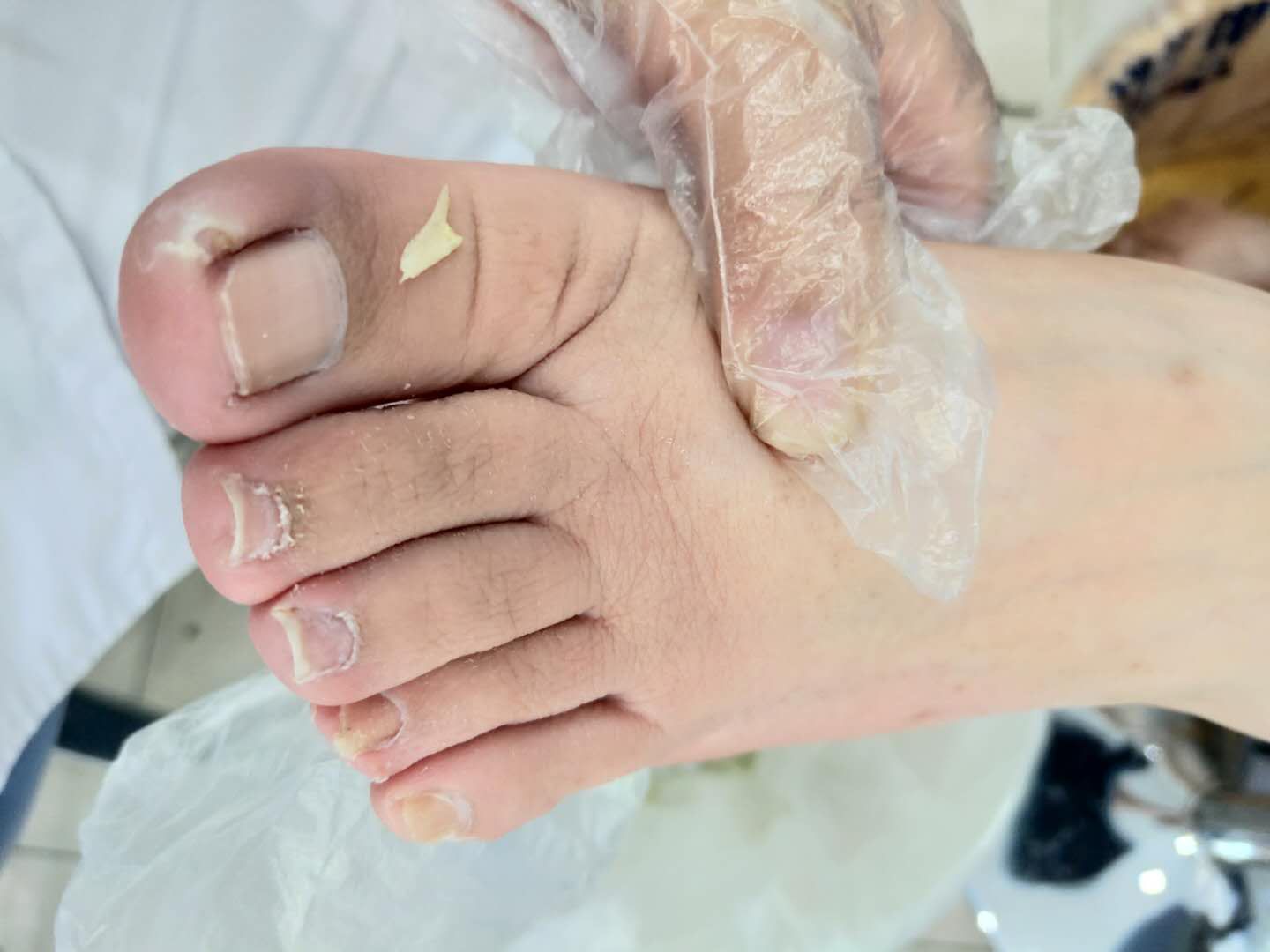 脚趾甲老往肉里长，得了“嵌甲”怎么办？医生：你需要了解这3点