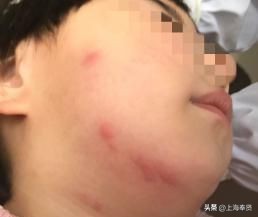 夏季被虫子咬了怎么办,夏季皮肤病攻略虫咬感染篇