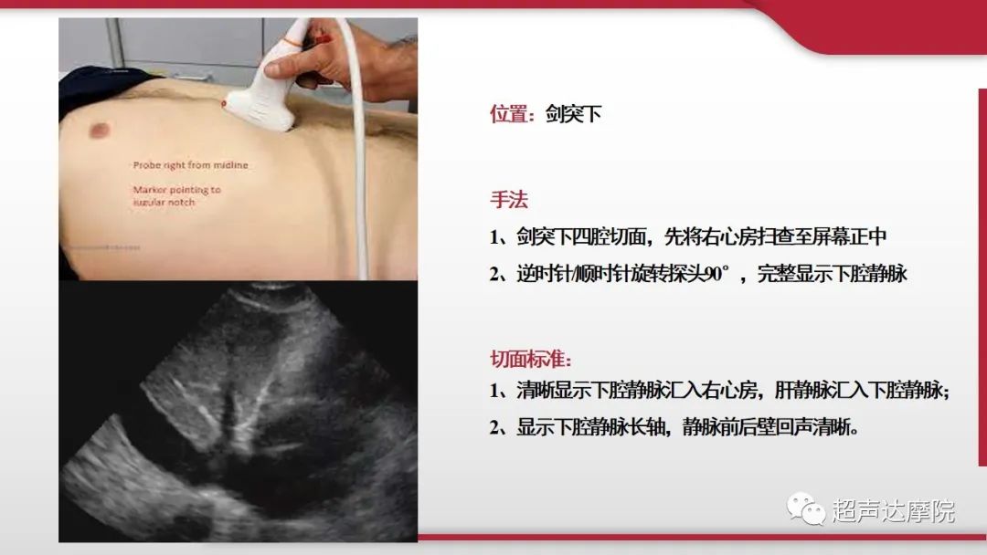 超声下腔静脉评估血容量,超声评估下腔静脉容量图片