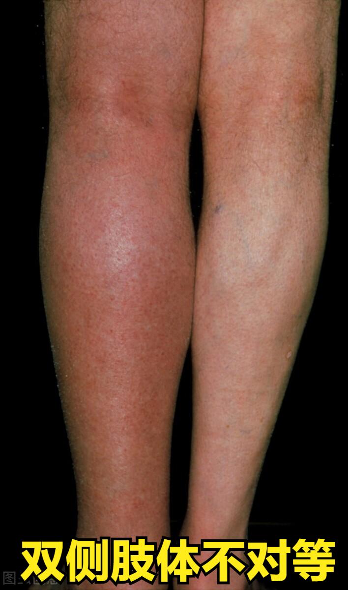 拇外翻手术后脚还在肿是什么原因,脚骨折手术后三个月还肿正常吗