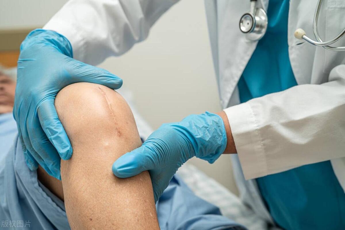 人工膝关节置换术的护理诊断,什么样的情况需要做膝关节置换术