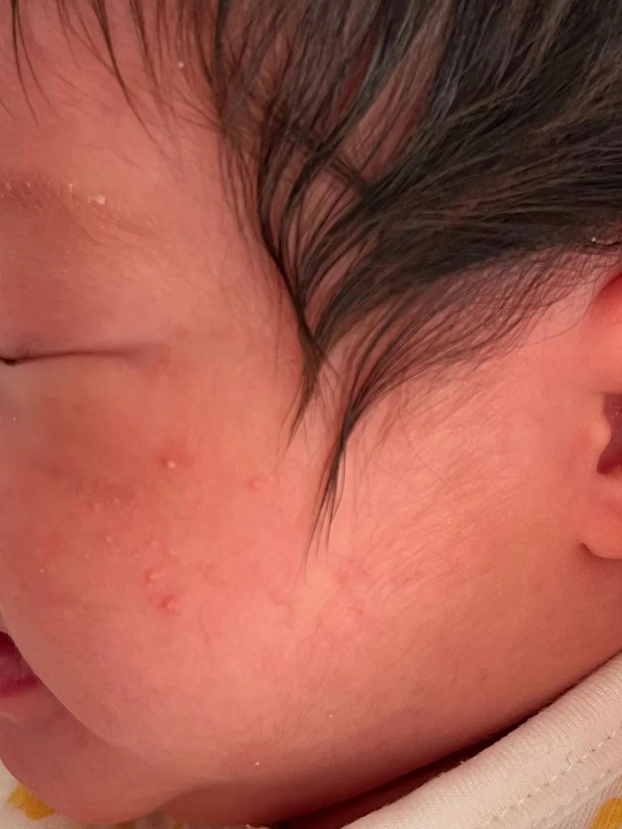 满月婴儿湿疹挂什么科,满月婴儿长湿疹抹什么药膏